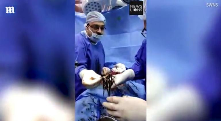Έβγαλαν 639 καρφιά από το στομάχι του – Του έσωσαν τη ζωή